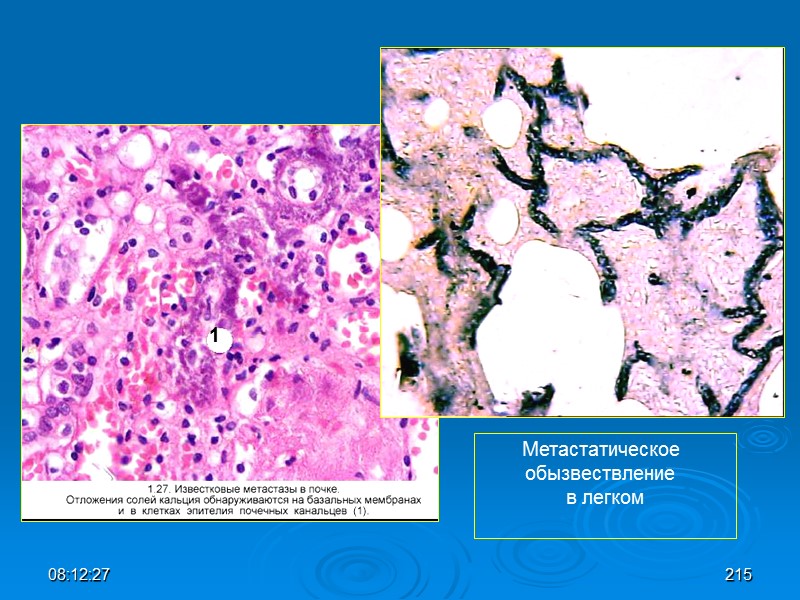 08:12:02 1 Метастатическое  обызвествление  в легком 215